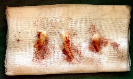 Avemu ritruvatu i denti di Battiston Avemu ritruvatu i denti di Battiston